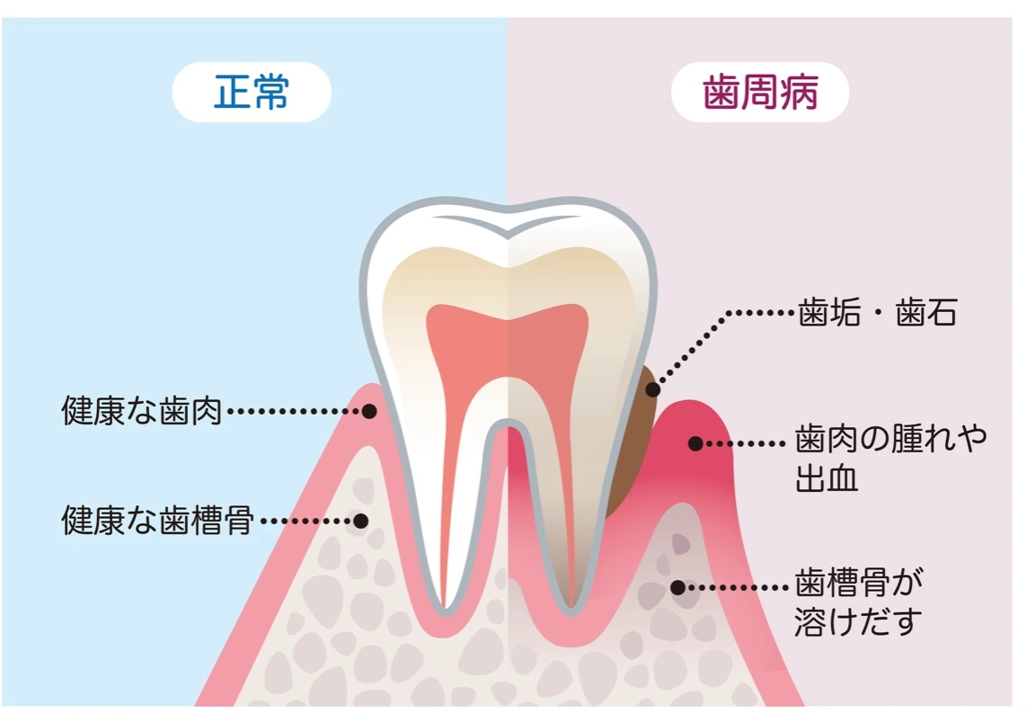 歯周病の治療/歯周病の予防