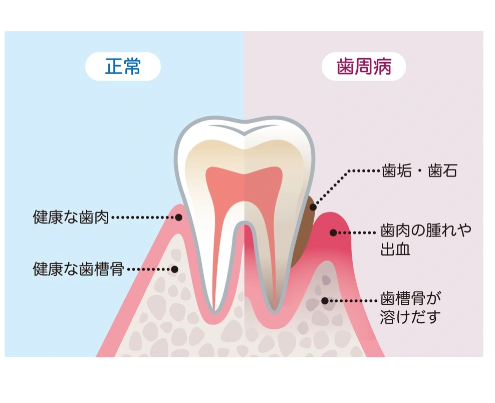 プラークコントロールと定期検診